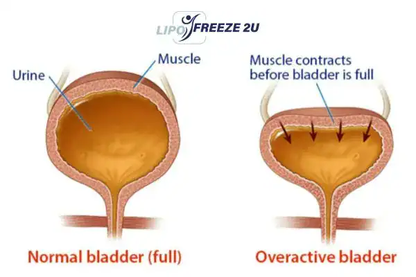 diagram of overactive bladder treatment Barking