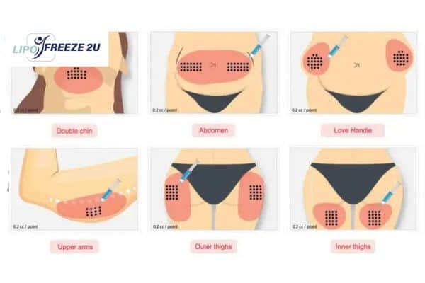 Benefits of Choosing Aqualyx for Fat Reduction Barking