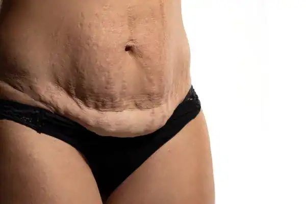 loose skin after weight loss injections Barking