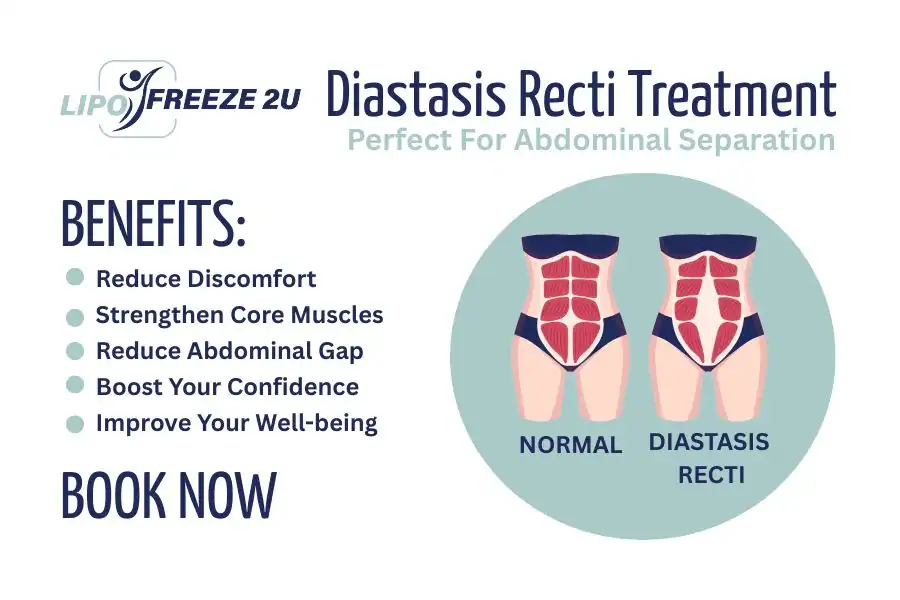 Benefits of body toning treatment Barking for Diastasis recti