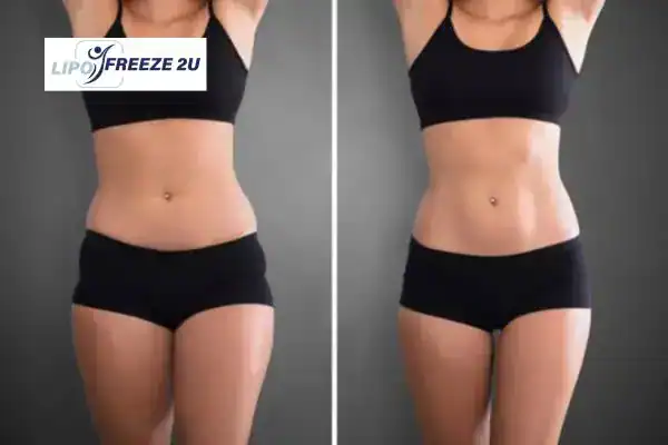 How Can LIPO FREEZE 2U Support Your Post-Pregnancy Body Recovery Barking?