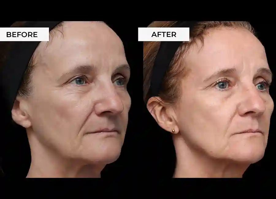 How Many RF Microneedling Sessions Will You Need to See a Difference Barking?