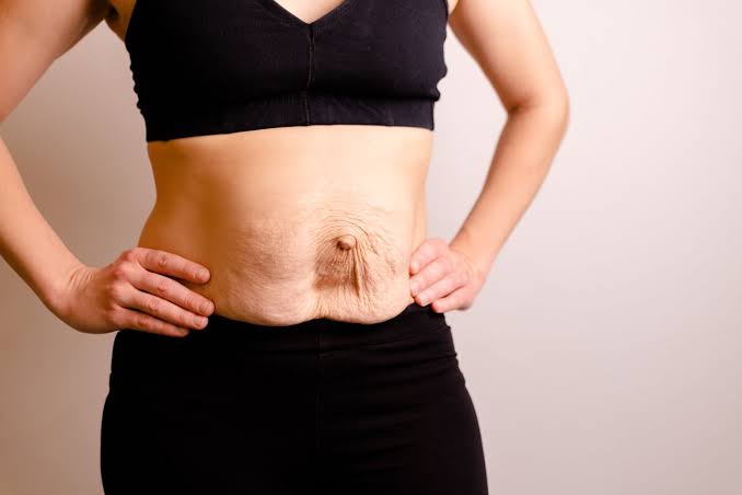 Is Surgery Really the Only Way to Repair Diastasis Recti Barking?