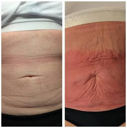 How Does RF Microneedling Improve Crepey, Thin and Uneven Skin Texture Barking?