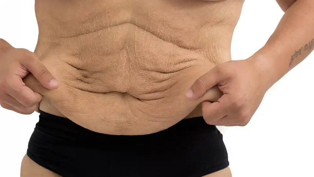 Why Does Weight Loss Medication Leave Some People With Loose or Sagging Skin Barking?